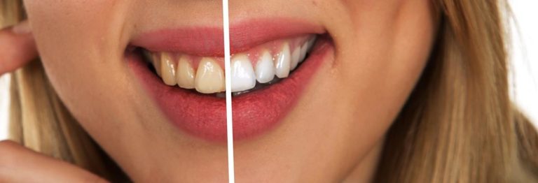 Typy metod leczenia krzywizny zębów